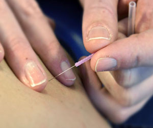 Dry Needling