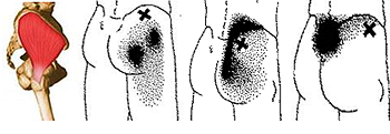 reffered pain